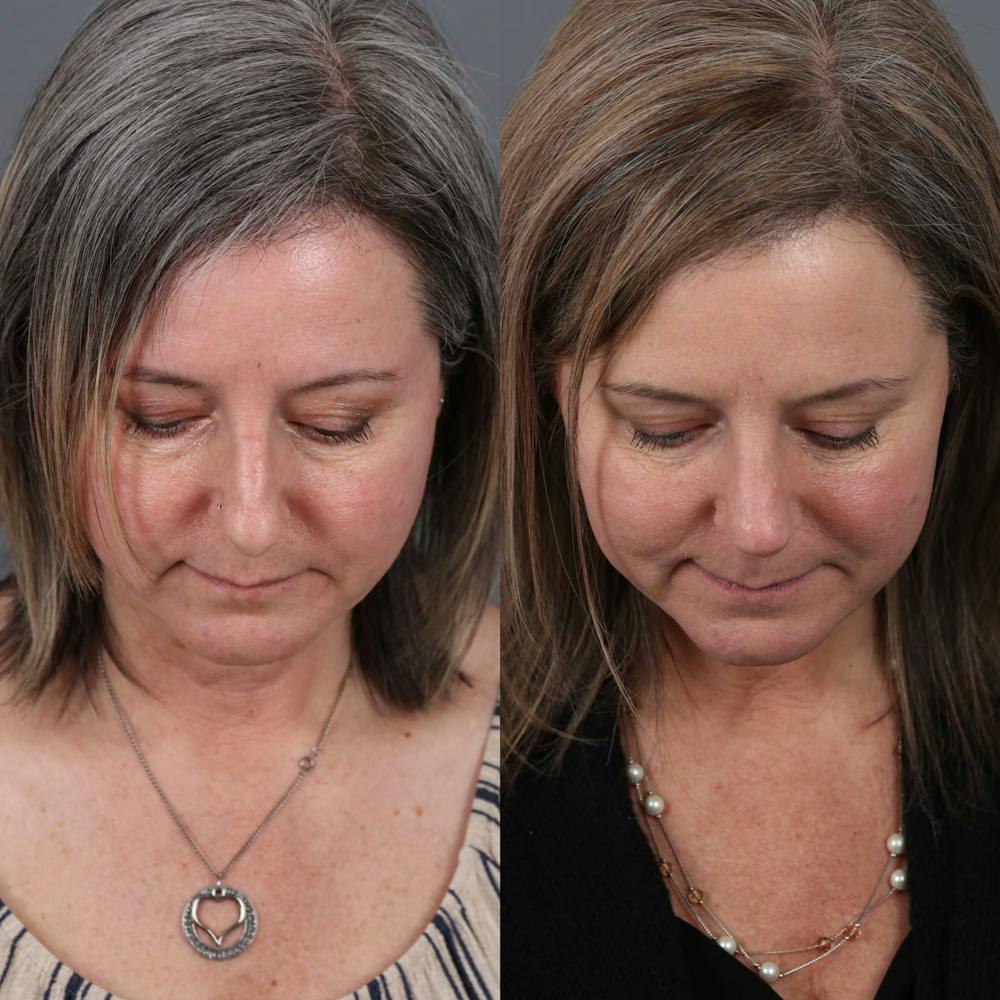 Rhinoplasty Before & After Gallery - Patient 143801768 - Image 5