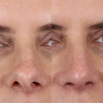 Rhinoplasty Before & After Gallery - Patient 143801769 - Image 2