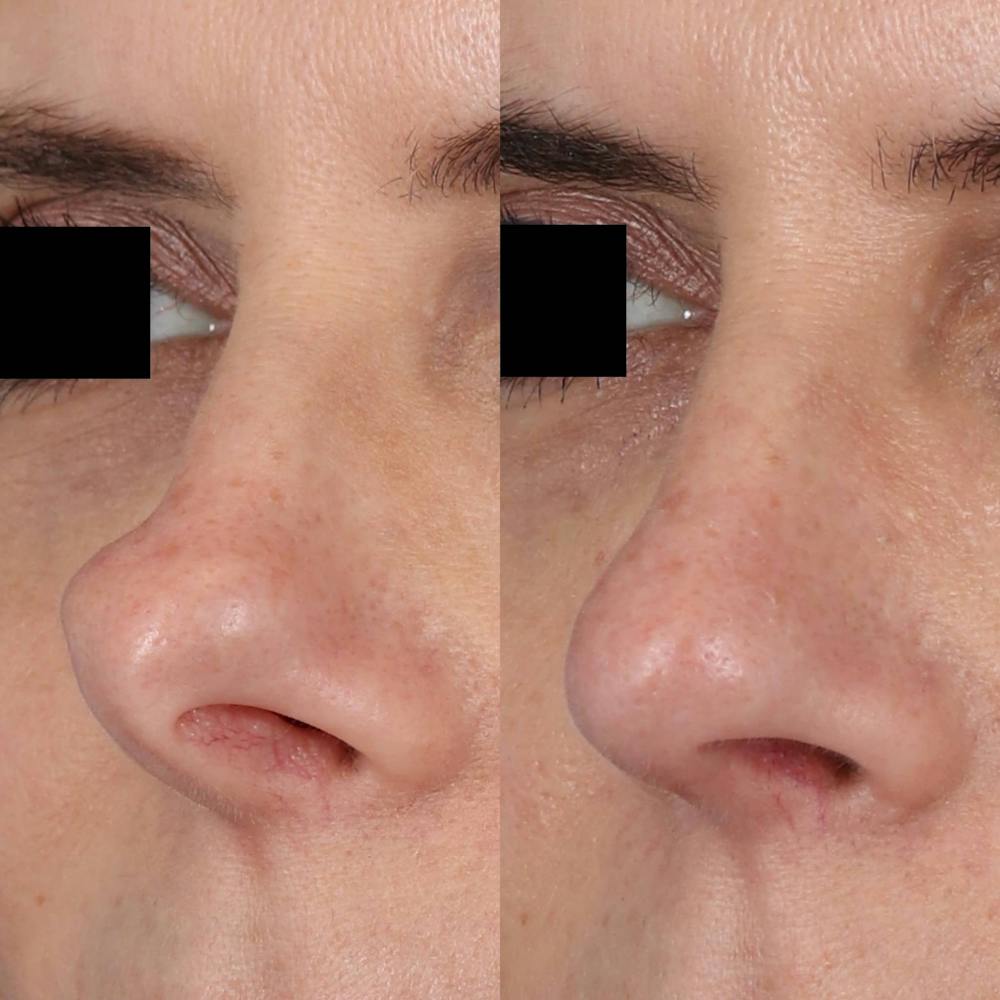 Rhinoplasty Before & After Gallery - Patient 143801769 - Image 3