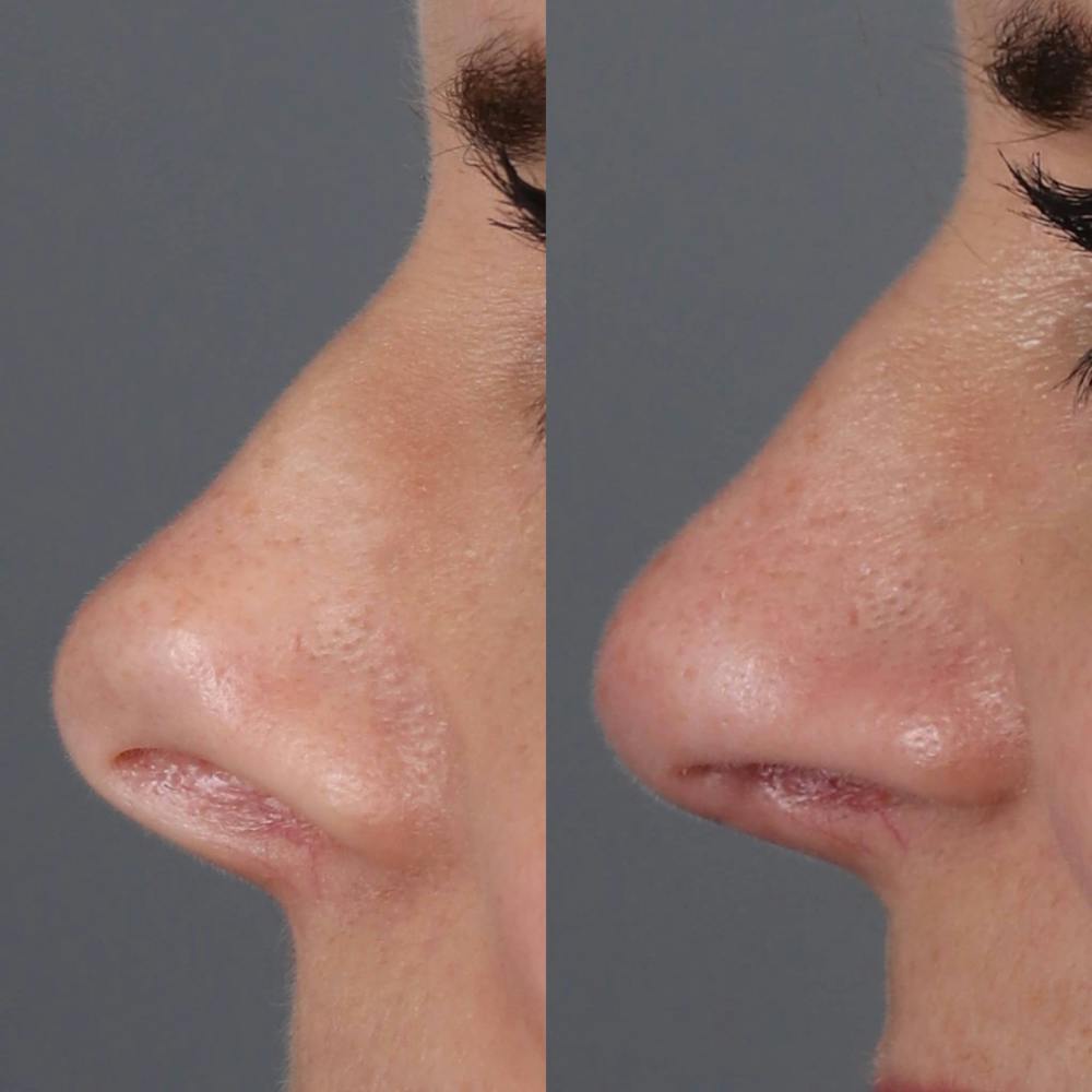 Rhinoplasty Before & After Gallery - Patient 143801769 - Image 1