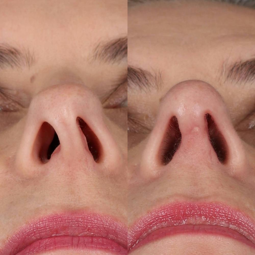 Rhinoplasty Before & After Gallery - Patient 143801769 - Image 4
