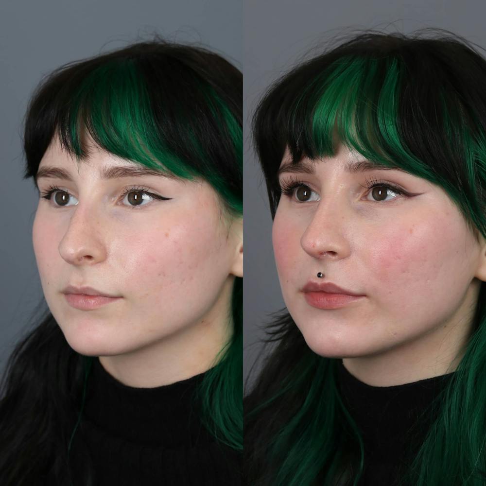 Rhinoplasty Before & After Gallery - Patient 143801770 - Image 3