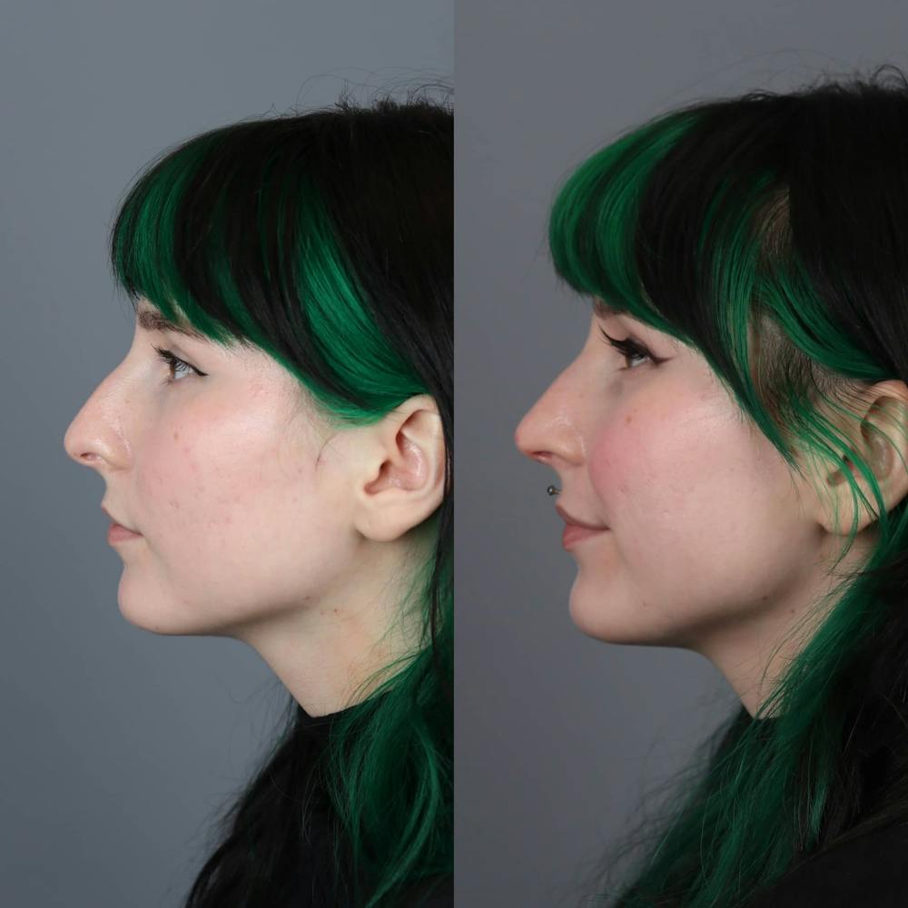 Rhinoplasty Before & After Gallery - Patient 143801770 - Image 1