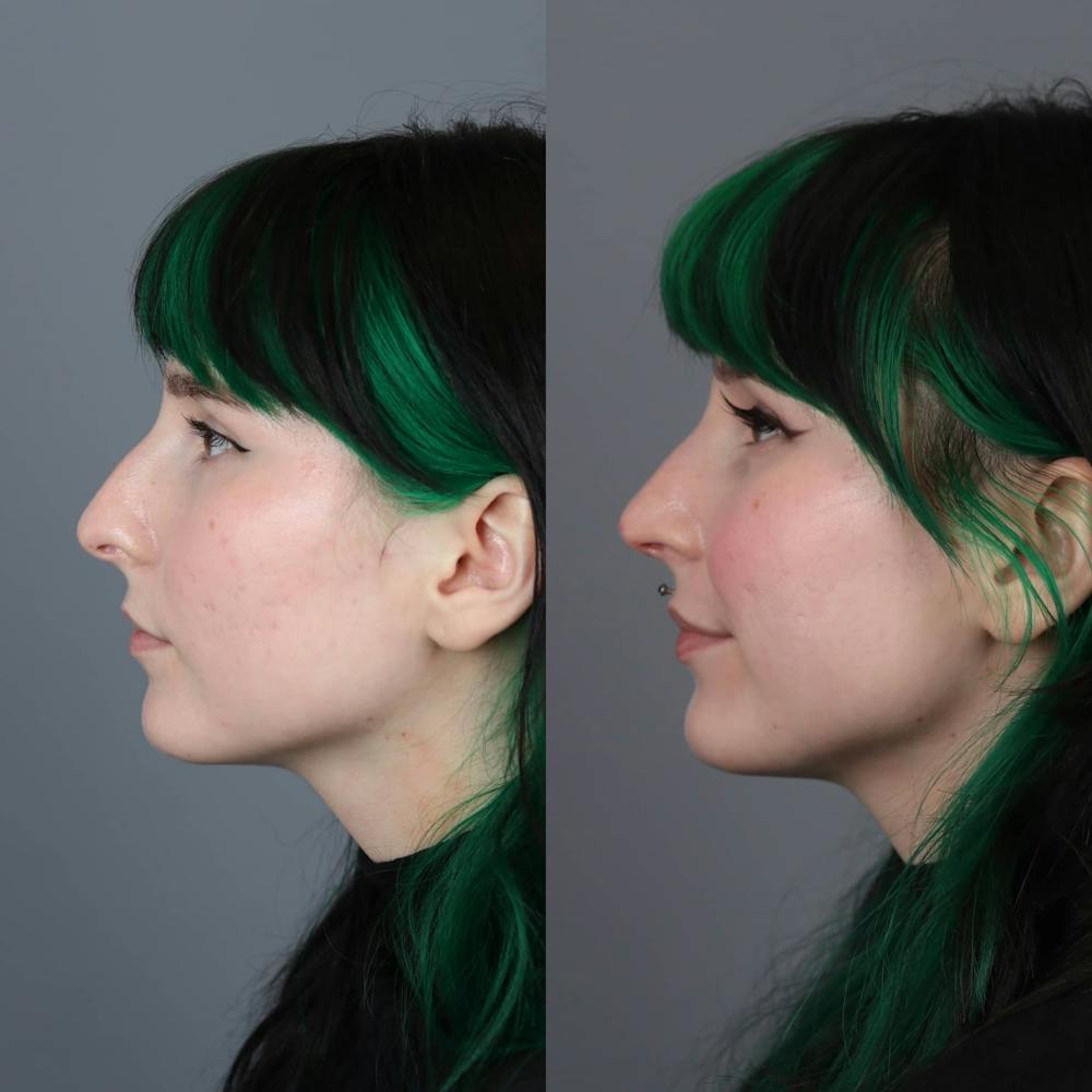 Rhinoplasty Before & After Gallery - Patient 143801770 - Image 3