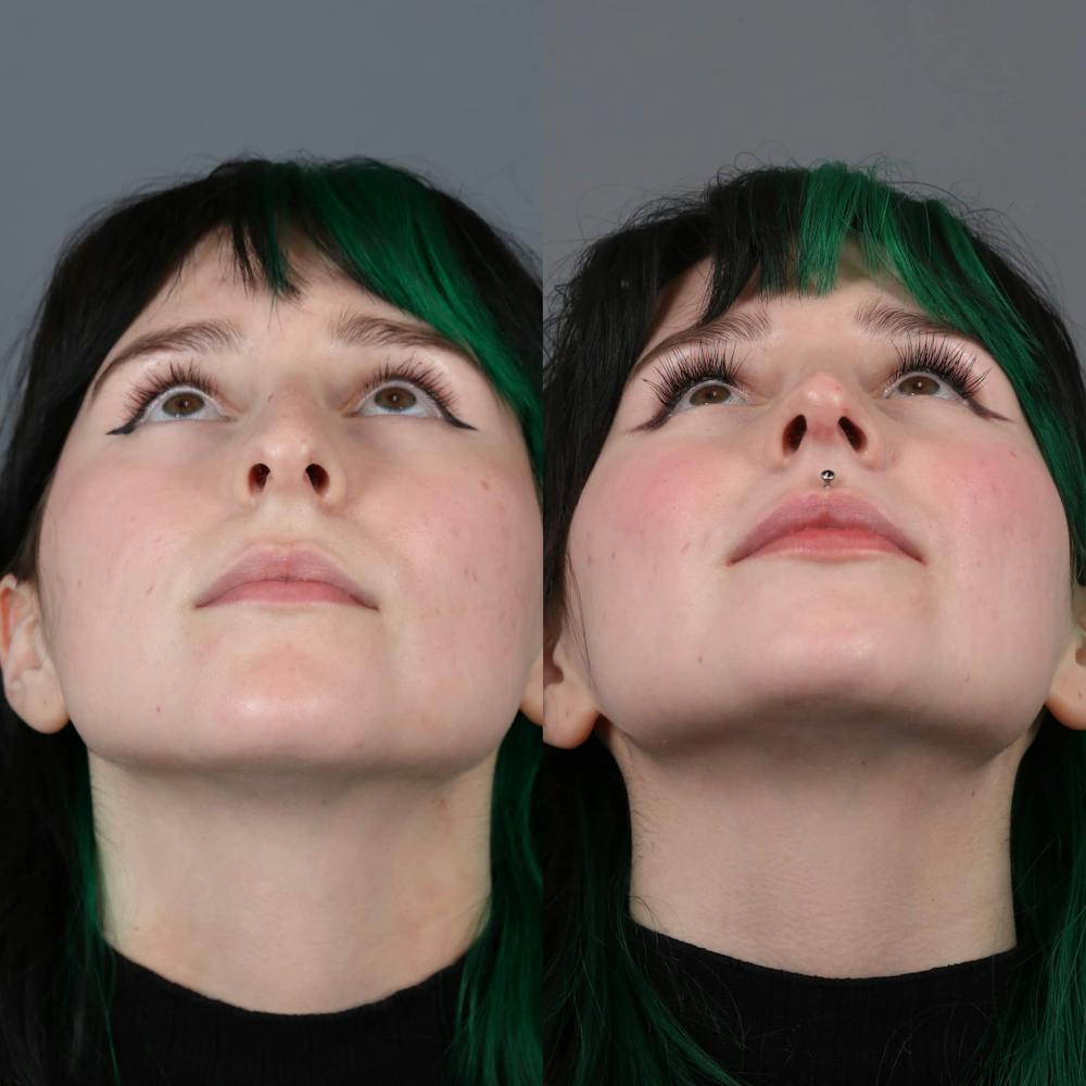 Rhinoplasty Before & After Gallery - Patient 143801770 - Image 4