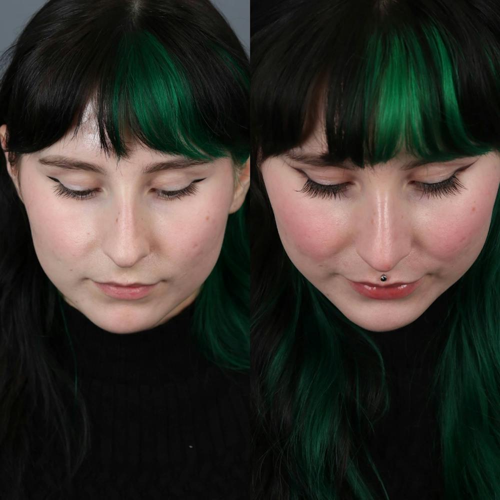 Rhinoplasty Before & After Gallery - Patient 143801770 - Image 5