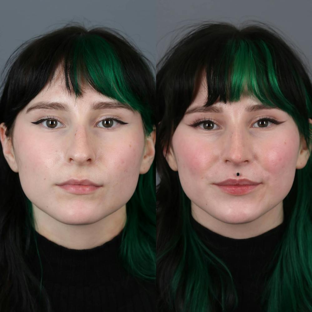 Rhinoplasty Before & After Gallery - Patient 143801770 - Image 1