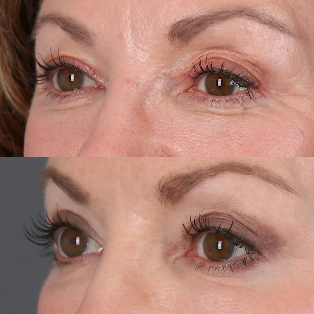 Upper Blepharoplasty Before & After Gallery - Patient 143801837 - Image 2