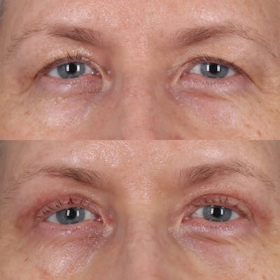 Upper Blepharoplasty Before & After Gallery - Patient 143801838 - Image 1