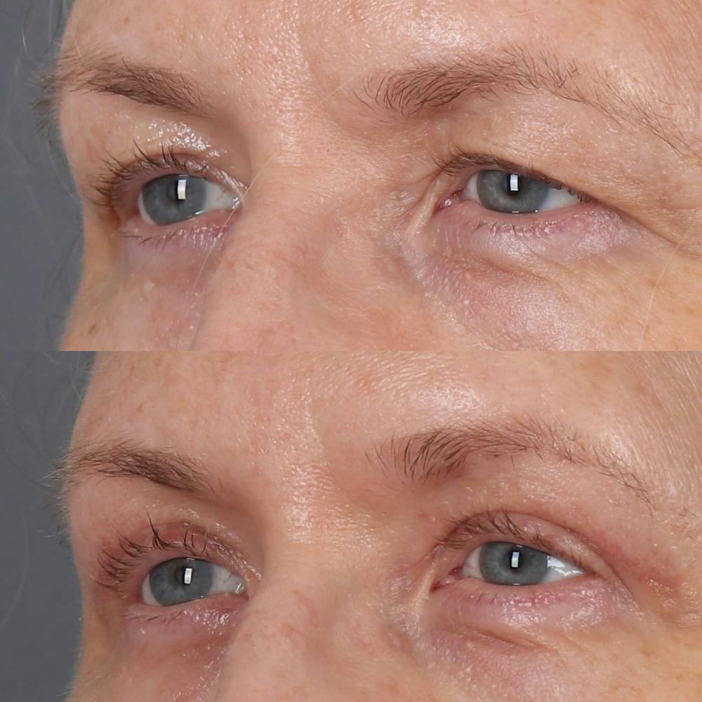 Upper Blepharoplasty Before & After Gallery - Patient 143801838 - Image 3