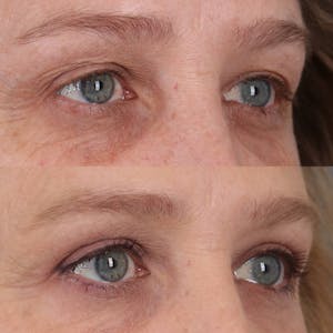 Blepharoplasty in Portland Before & After Photos