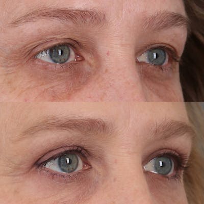 Upper Blepharoplasty Before & After Gallery - Patient 143805077 - Image 2