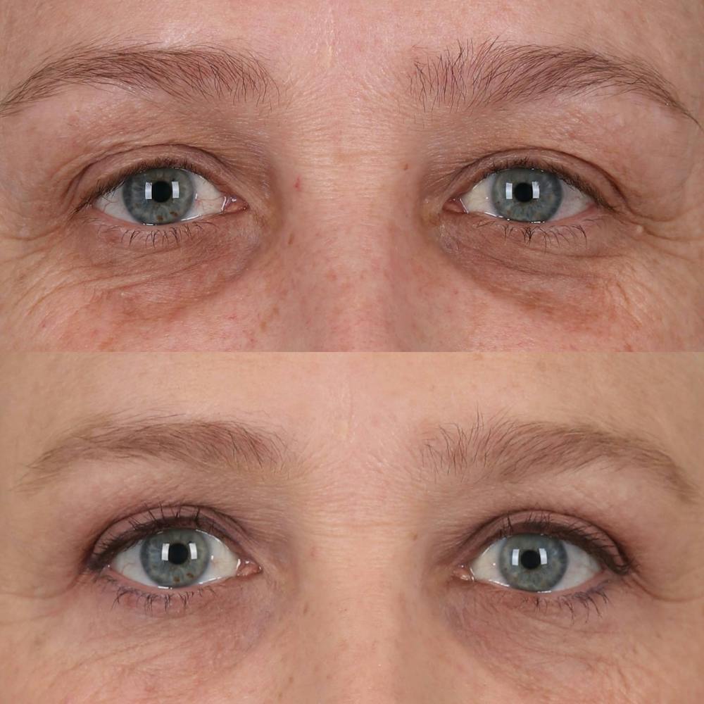 Upper Blepharoplasty Before & After Gallery - Patient 143805077 - Image 1