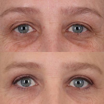 Upper Blepharoplasty Before & After Gallery - Patient 143805077 - Image 1