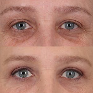 Blepharoplasty in Portland Before & After Photos