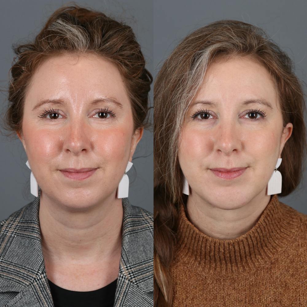 Face & Neck Lift Before & After Gallery - Patient 177621204 - Image 4