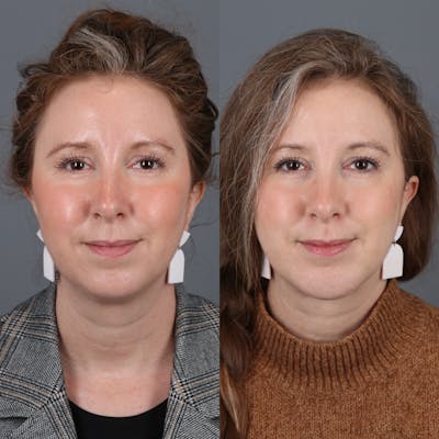 Face & Neck Lift Before & After Gallery - Patient 177621204 - Image 4