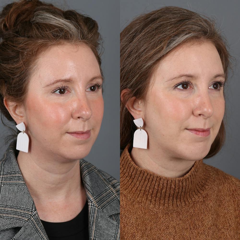 Face & Neck Lift Before & After Gallery - Patient 177621204 - Image 1