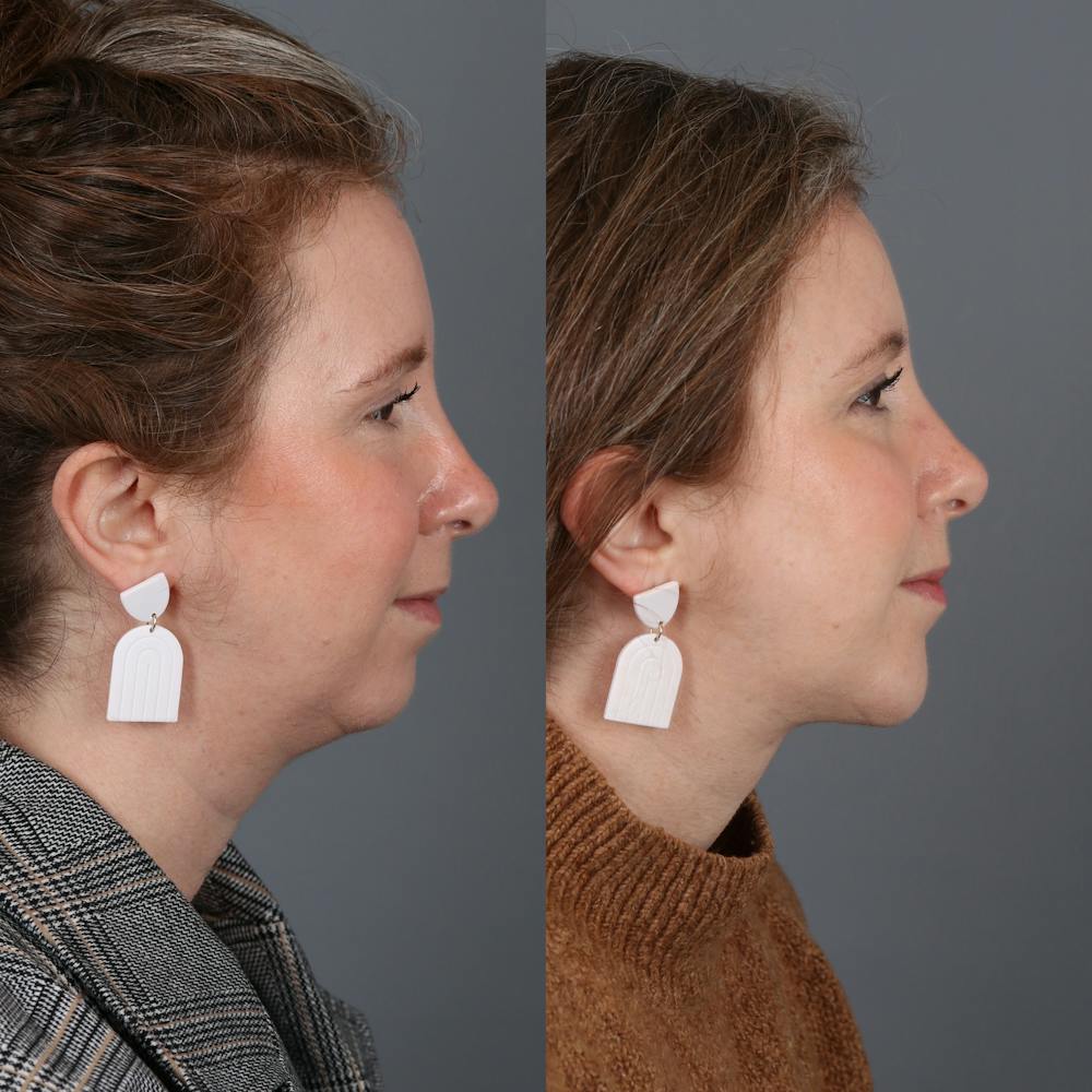 Chin Implant Before & After Gallery - Patient 144315327 - Image 1