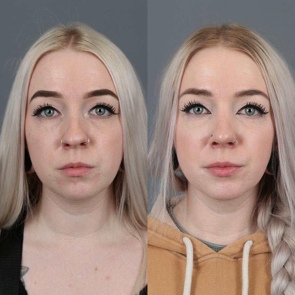 Rhinoplasty Before & After Gallery - Patient 144315331 - Image 2
