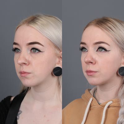Rhinoplasty Before & After Gallery - Patient 144315331 - Image 2