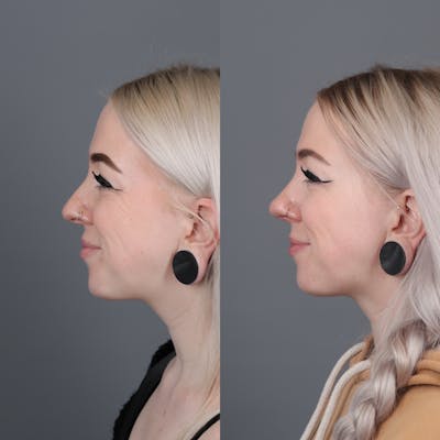 Rhinoplasty Before & After Gallery - Patient 144315331 - Image 4