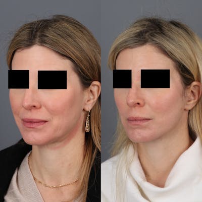 Face & Neck Lift Before & After Gallery - Patient 146193778 - Image 1