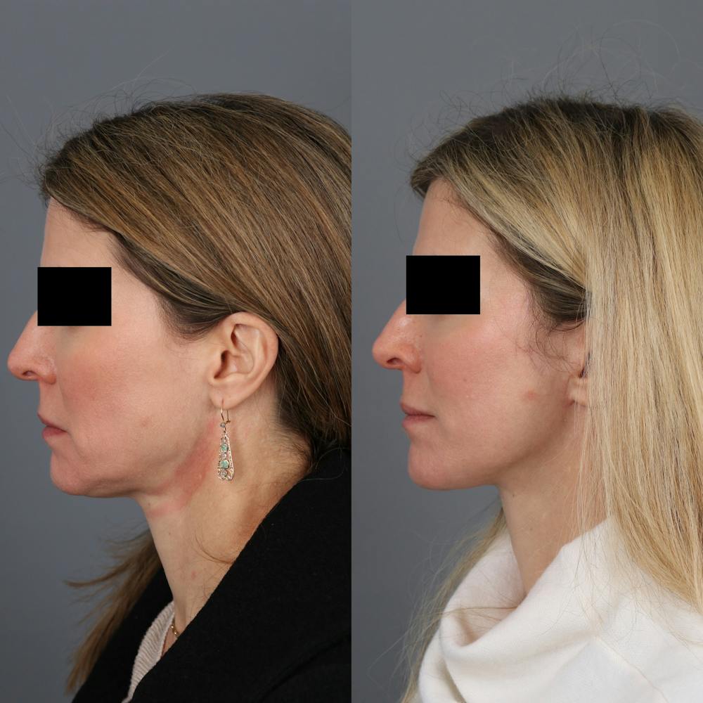Facelift Before & After Gallery - Patient 146193778 - Image 3