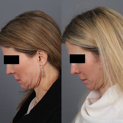 Facelift Before & After Gallery - Patient 146193778 - Image 4