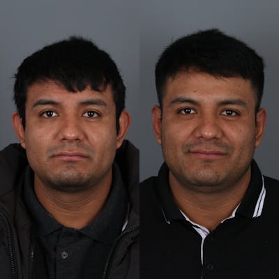 Otoplasty Before & After Gallery - Patient 147032478 - Image 1