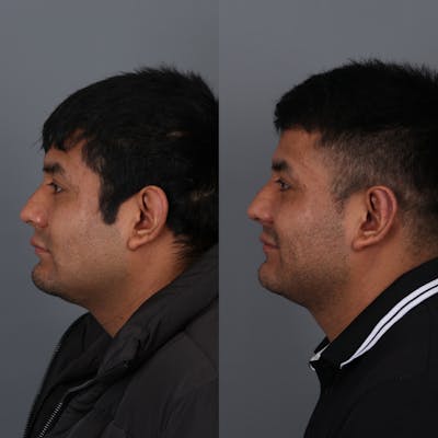 Otoplasty Before & After Gallery - Patient 147032478 - Image 4