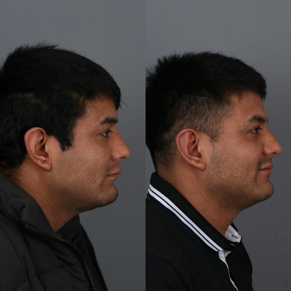 Otoplasty Before & After Gallery - Patient 147032478 - Image 5