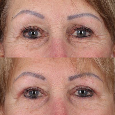 Upper Blepharoplasty Before & After Gallery - Patient 147032719 - Image 1