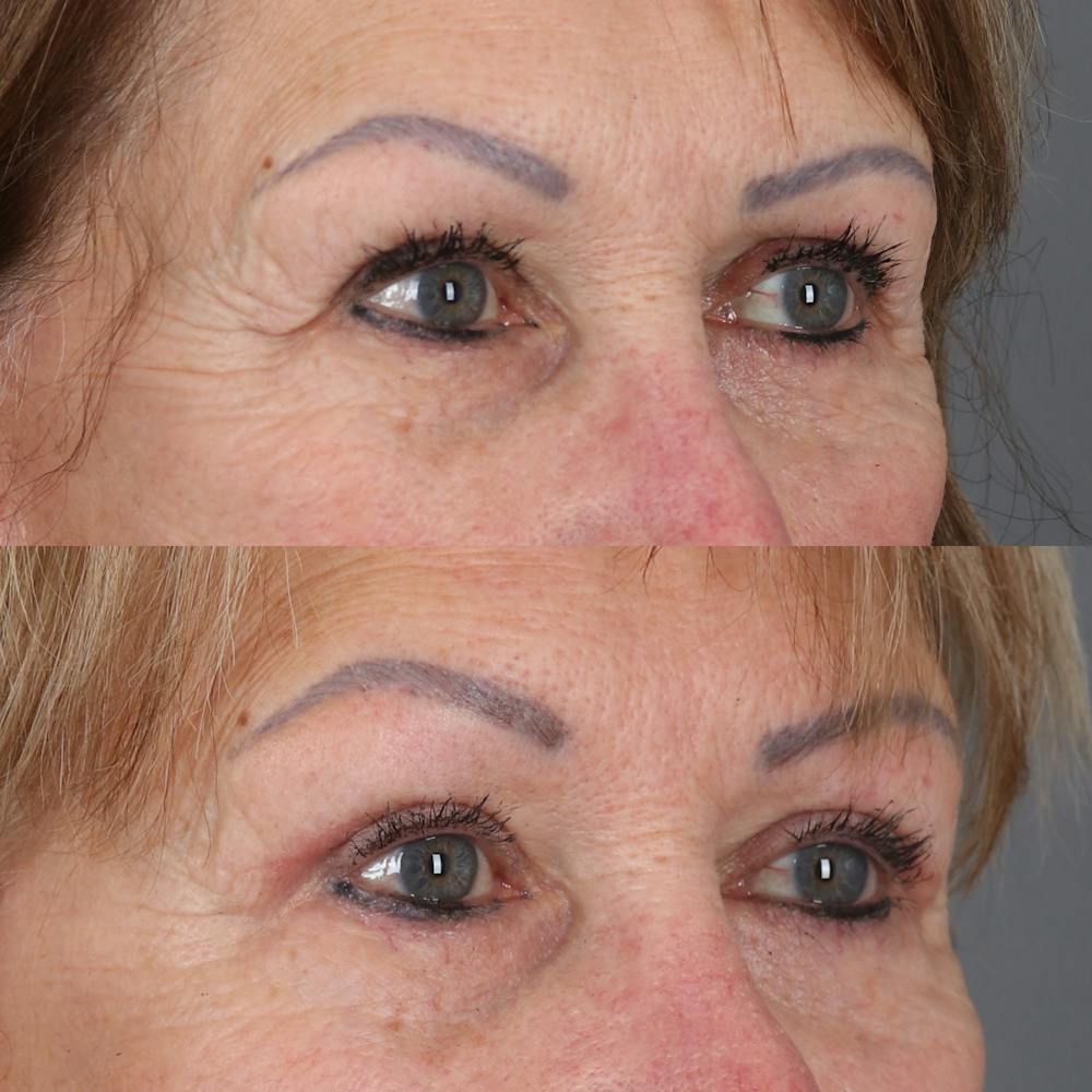Upper Blepharoplasty Before & After Gallery - Patient 147032719 - Image 2