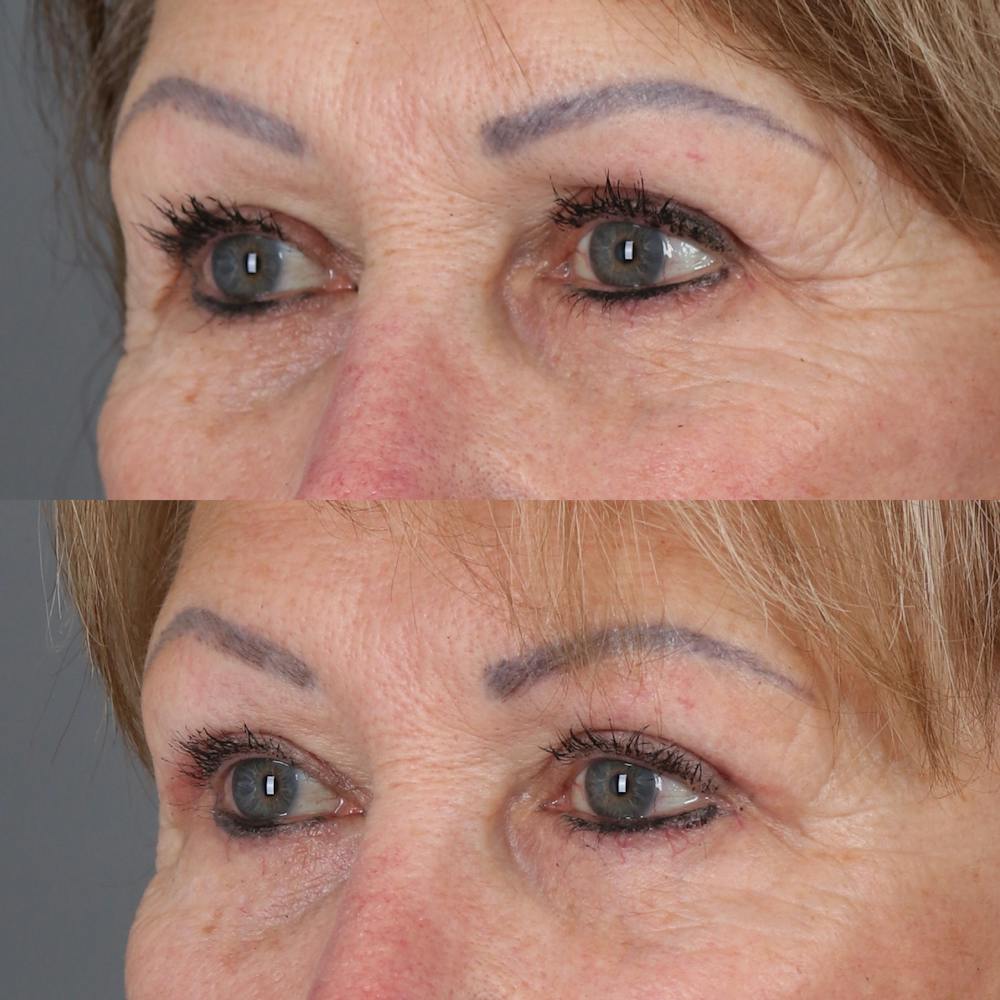 Upper Blepharoplasty Before & After Gallery - Patient 147032719 - Image 3