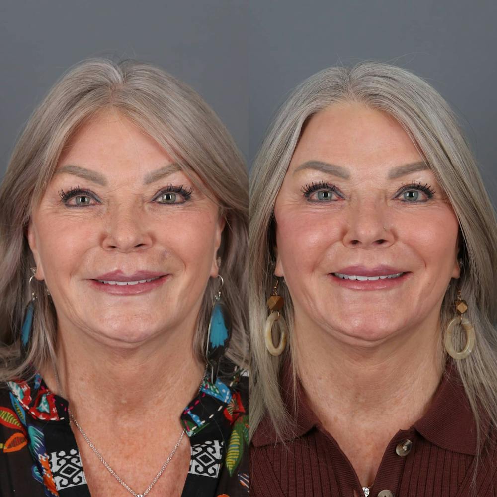 Lip Lift Before & After Gallery - Patient 147447695 - Image 3