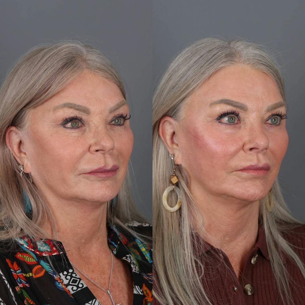 Lip Lift Before & After Gallery - Patient 147447695 - Image 4