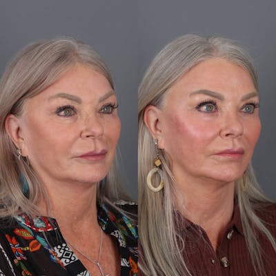 Lip Lift Before & After Gallery - Patient 147447695 - Image 4