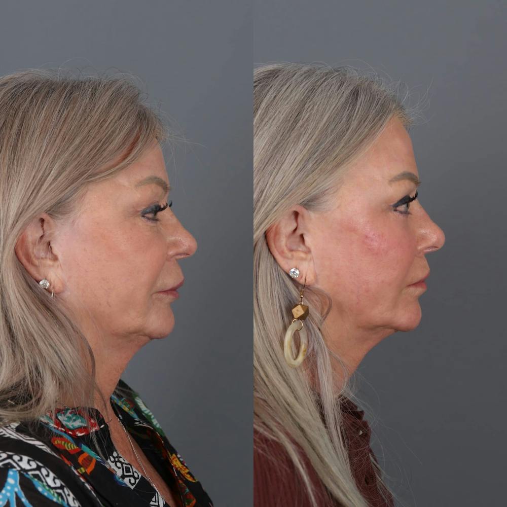 Lip Lift Before & After Gallery - Patient 147447695 - Image 5