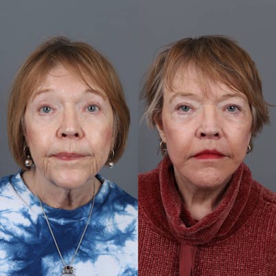 Facelift Before & After Gallery - Patient 147447962 - Image 1