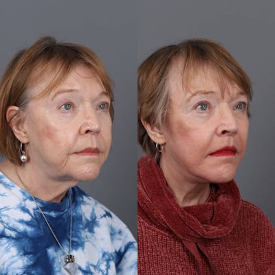 Neck Lift  Before & After Gallery - Patient 147448005 - Image 2