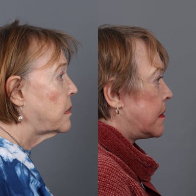 Neck Lift  Before & After Gallery - Patient 147448005 - Image 1