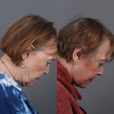 Facelift Before & After Gallery - Patient 147447962 - Image 4