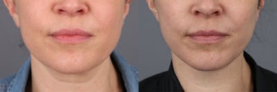 Face & Neck Lift Before & After Gallery - Patient 177621070 - Image 4