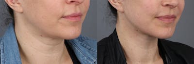 Neck Lift  Before & After Gallery - Patient 148239965 - Image 4