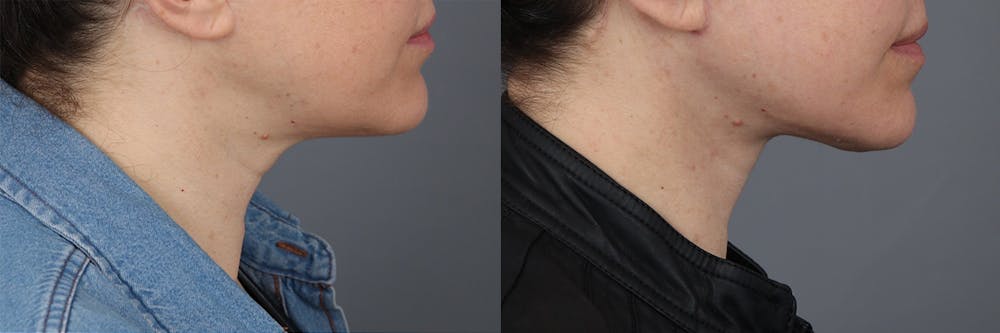 Neck Lift  Before & After Gallery - Patient 148239965 - Image 1