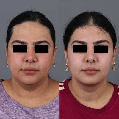 Forehead Reduction Before & After Gallery - Patient 148472138 - Image 1