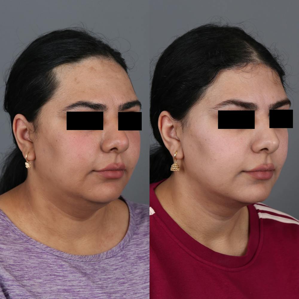 Forehead Reduction Before & After Gallery - Patient 148472138 - Image 2