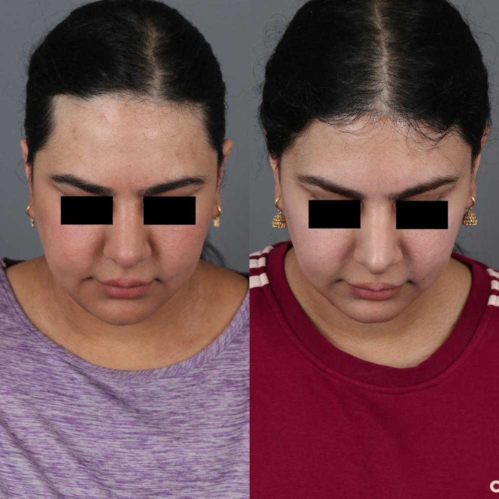 Forehead Reduction Before & After Gallery - Patient 148472138 - Image 3