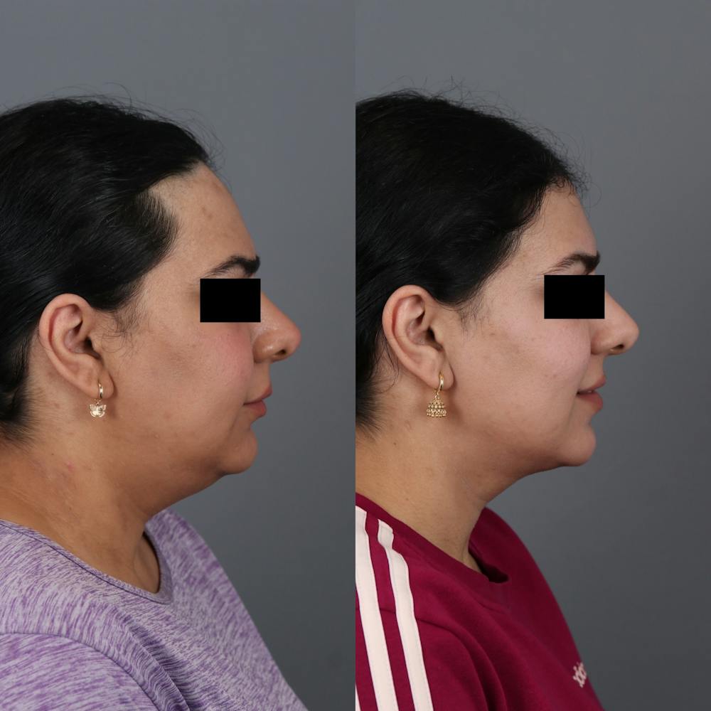Forehead Reduction Before & After Gallery - Patient 148472138 - Image 4